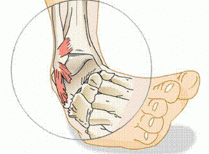 sürgősségi ellátás boka sérülések esetén tánc után fájnak a lábak ízületei